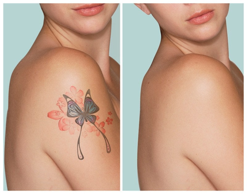 Как работает лазерное удаление татуировки?