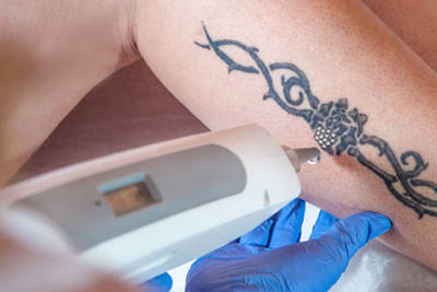 Удаление татуировок и пигмента лазером